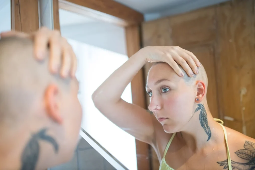 baldness treatment options